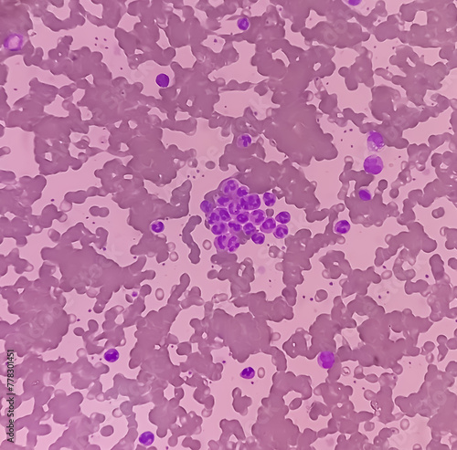 Cold agglutinins disease, RBCs to clump together (agglutinate) at low temperatures, autoimmune hemolytic anemia, anisocytosis anisochromia with macrocytes echinocytes seen. macrocytic anemia. photo