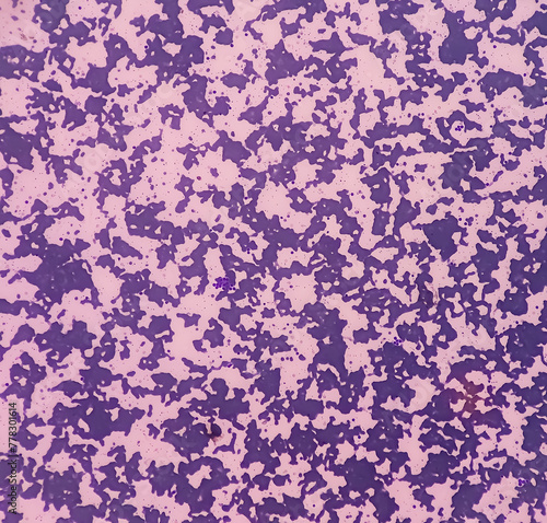 Cuadro en lienzo Cold agglutinins disease, RBCs to clump together (agglutinate) at low temperatures, autoimmune hemolytic anemia, anisocytosis anisochromia with macrocytes echinocytes seen