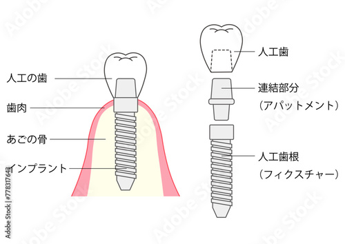 インプラントの構造