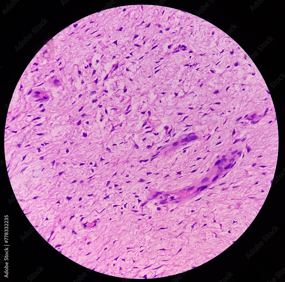 Fibromyxoma. Leg tissue biopsy: Sections microscopically show features ...