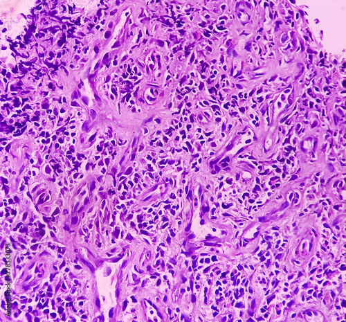 Larynx Cancer. Invasive squamous cell carcinoma. Section show malignant neoplasm. photo