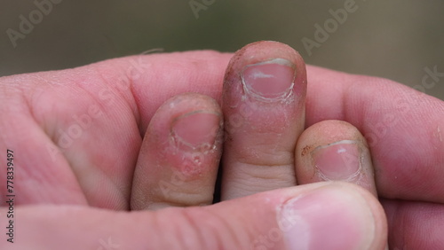 The child bites his nails and fingers