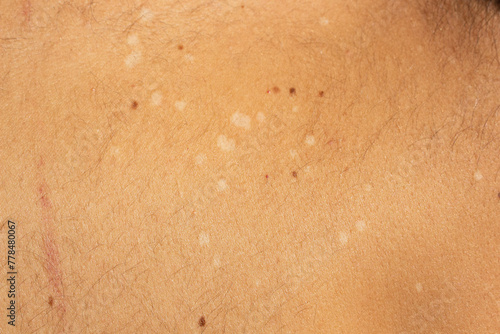 Skin Condition: Tinea Versicolor. Lack of pigmentation photo