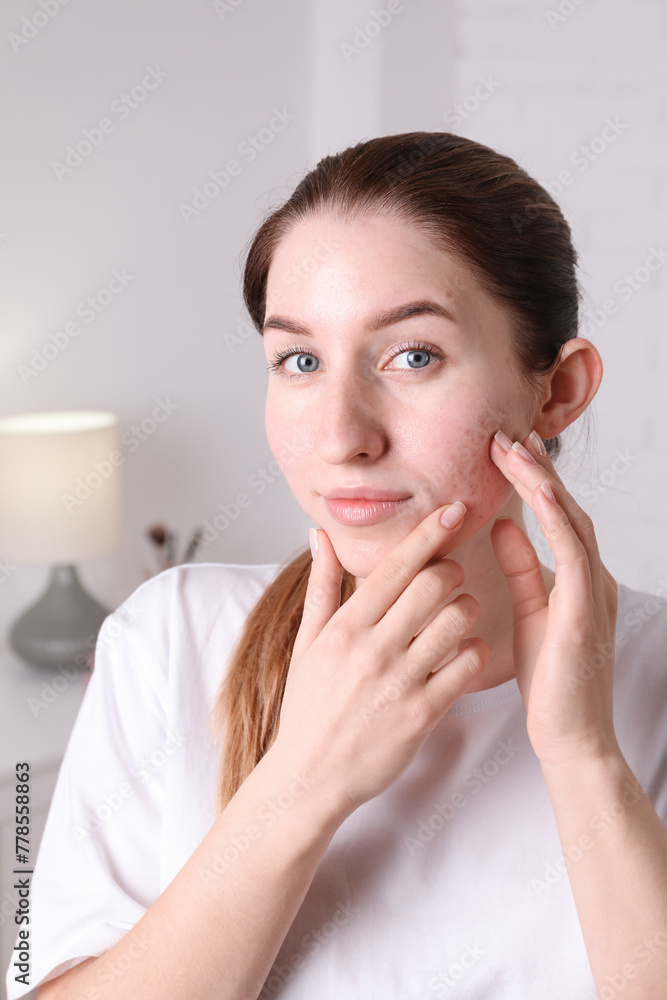 Young woman with acne problem at home - obrazy, fototapety, plakaty 