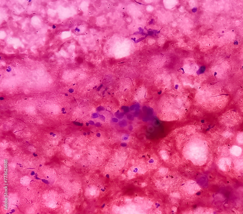 FNA from paravertebral mass. Suppurative inflammation. Smear show plenty of degenerated and intact polymorphs, lymphocytes and histiocytes. photo