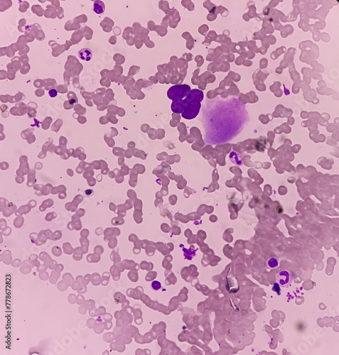 Acute leukemia, ALL(Acute lymphoblastic leukemia), peripheral blood smear. abnormal hematological blood cell. Bone marrow study. photo