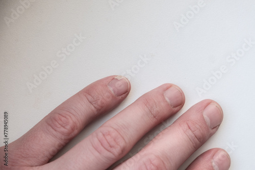 male hand with a broken nail on the little finger