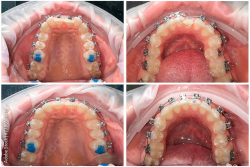 Close-up photo before and after braces are installed. Upper and lower jaw.