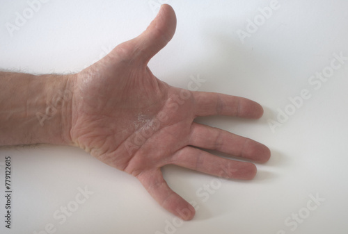 Neurodermitis Hand trocken