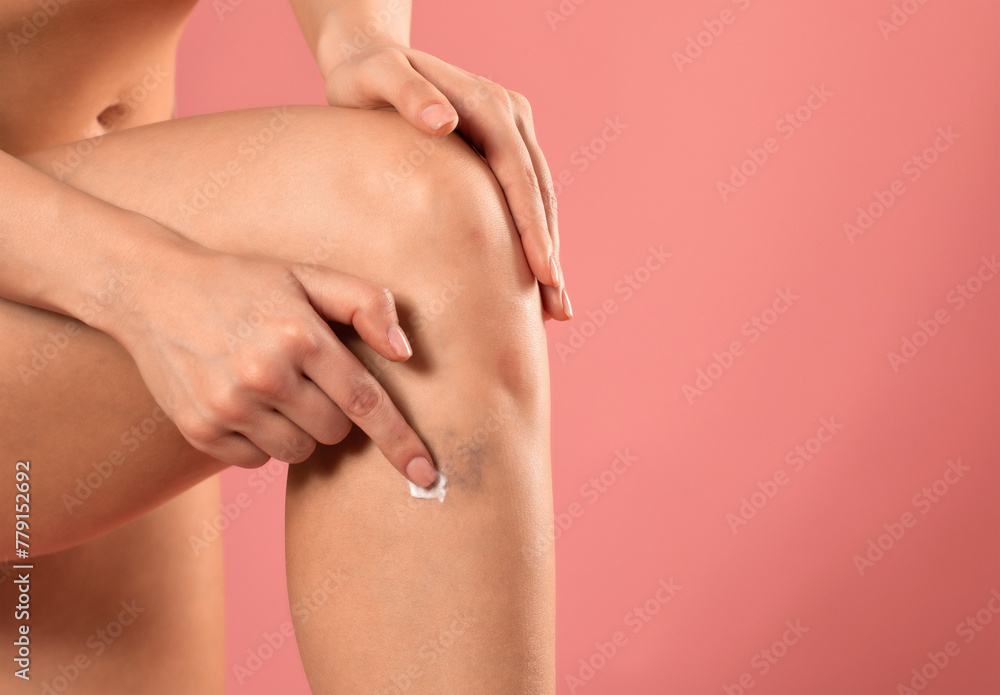 A girl applies healing ointment to a bruise on her knee. Close-up of a bruise on a woman's leg.