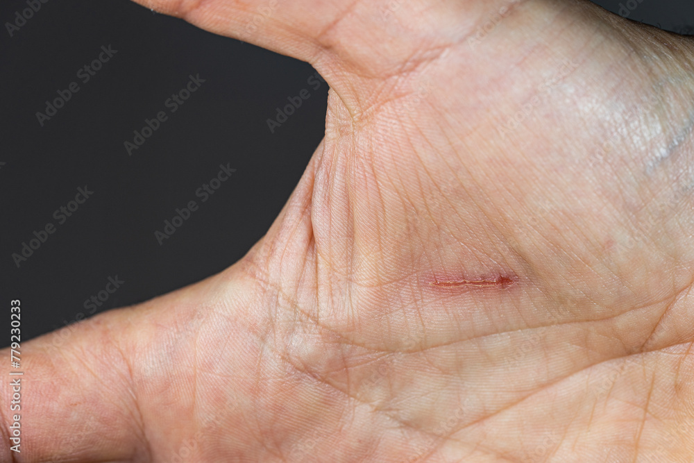 Part of human hand palm with wound caused by plant spikes Part of human hand palm with wound caused by plant spikes
