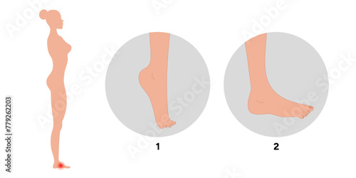 Special exercise for food deformation problem. Orthopedist Therapeutic and strengthening foot