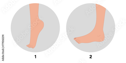 Special exercise for food deformation problem. Orthopedist Therapeutic and strengthening foot