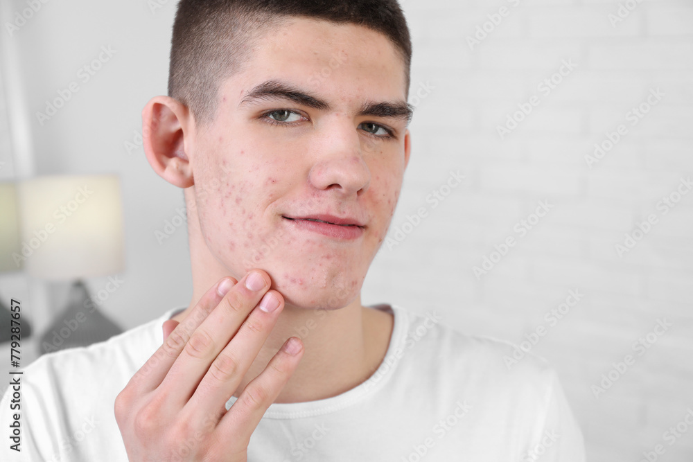Young man touching pimple on his face indoors. Acne problem Young man touching pimple on his face indoors. Acne problem