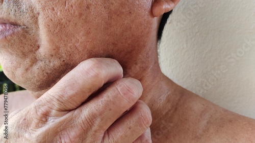 portrait the hand scratching the rash hives and allergy  reaction and blackhead  scar and freckles  blemish and acne on the neck  allergic and flabby skin on the body of the male patient.