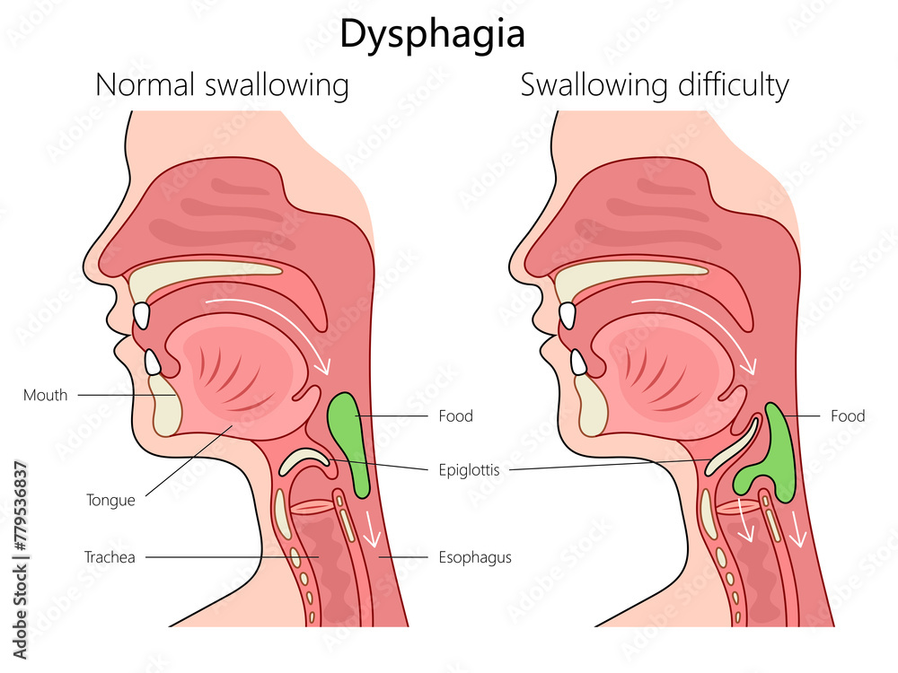dysphagia swallowing difficulty and normal swallowing with labeled anatomy structure vertebral column diagram hand drawn schematic raster illustration. Medical science educational illustration - obrazy, fototapety, plakaty 