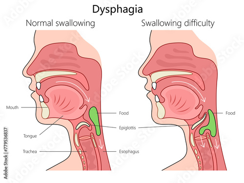 dysphagia swallowing difficulty and normal swallowing with labeled anatomy structure vertebral column diagram hand drawn schematic raster illustration. Medical science educational illustration © Oleksandr Pokusai