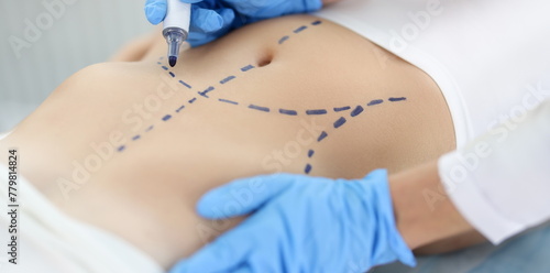 Obraz na płótnie Doctor plastic surgeon drawing preoperative markings on skin of patient abdomen closeup. Plastic surgery and aesthetic medicine liposuction concept w salonie