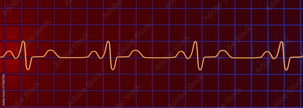 ECG of bundle branch block, 3D illustration