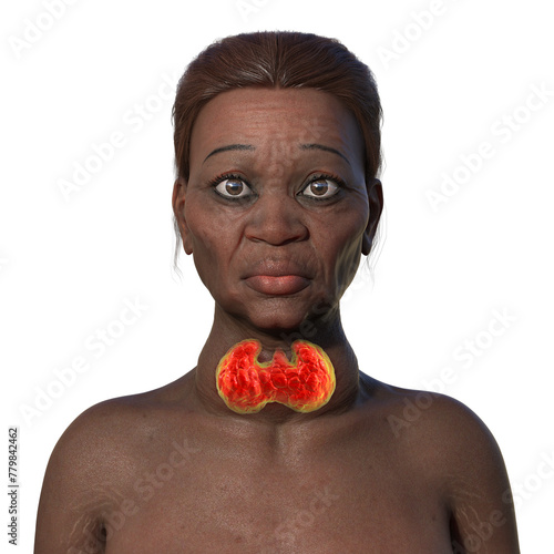 Grave's disease in a woman, 3D illustration
