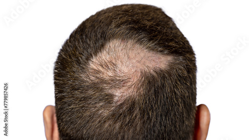 Person with Hair Loss problems closeup. Alopecia Balding Hairs on man Scalp. Human Alopecia or Hair Loss. Scratching his Head. Baldness. Depression, Stress. PNG Design Element.