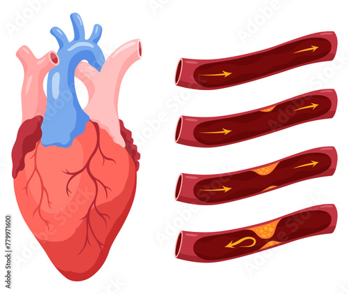 Atherosclerosis stages. Anatomy of heart attack. Arteriosclerotic vascular disease or ASVD. Atherosclerotic plaque in coronary artery. Vector illustration on white background