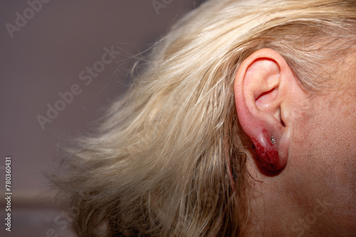 Inflamed earlobe after ear piercing
