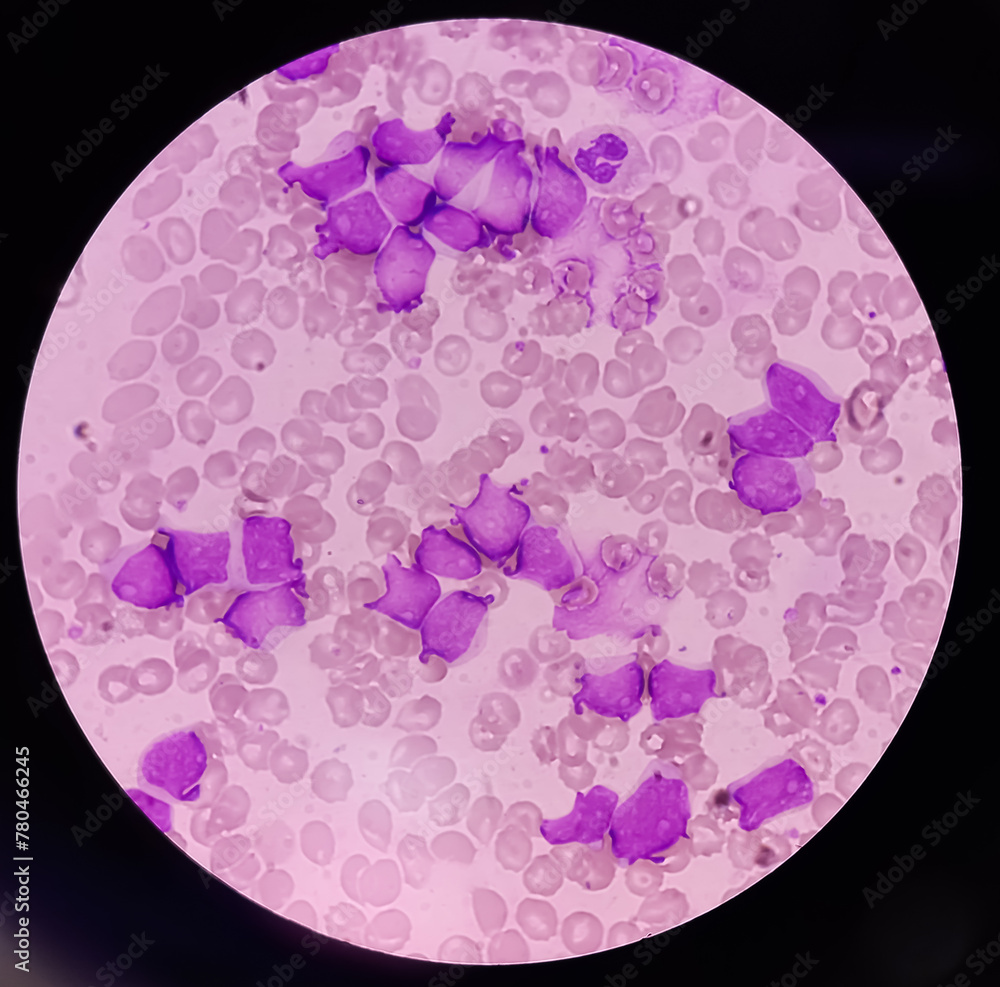 Acute Leukemia ALL Acute Lymphoblastic Leukemia Peripheral Blood 