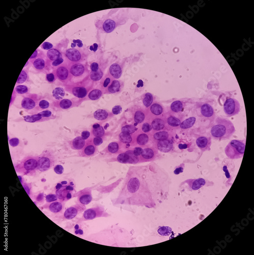 Pap's smear. Inflammatory smear with HPV related changes. Cervical cancer. SCC. photo