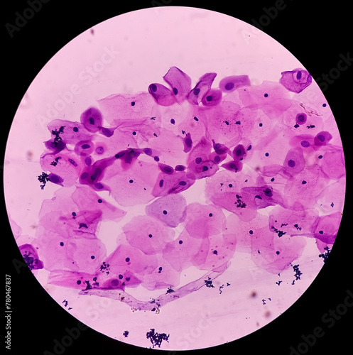 Pap's smear. Inflammatory smear with HPV related changes. Cervical cancer. SCC. photo