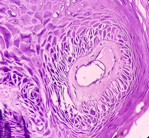 Squamous papilloma of maxilla to the human papilloma virus (HPV), Squamous cell papilloma, benign growth. photo