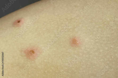 Obraz na plátně Scratched pimples on human skin