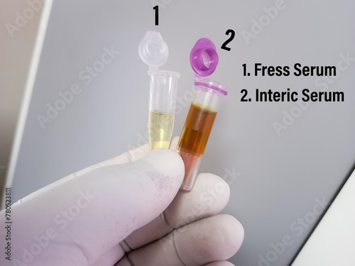 Scientist hold sample cup with icteric serum for test in laboratory. Hyperbilirubinemia, which can cause false laboratory test result. photo