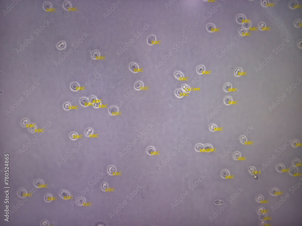 Urine Rbc Cells RBC in Urine microscopy. Abnormal result of urinalysis examination ...
