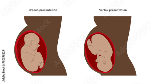 breech presentation