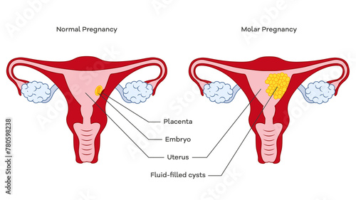 molar pregnancy