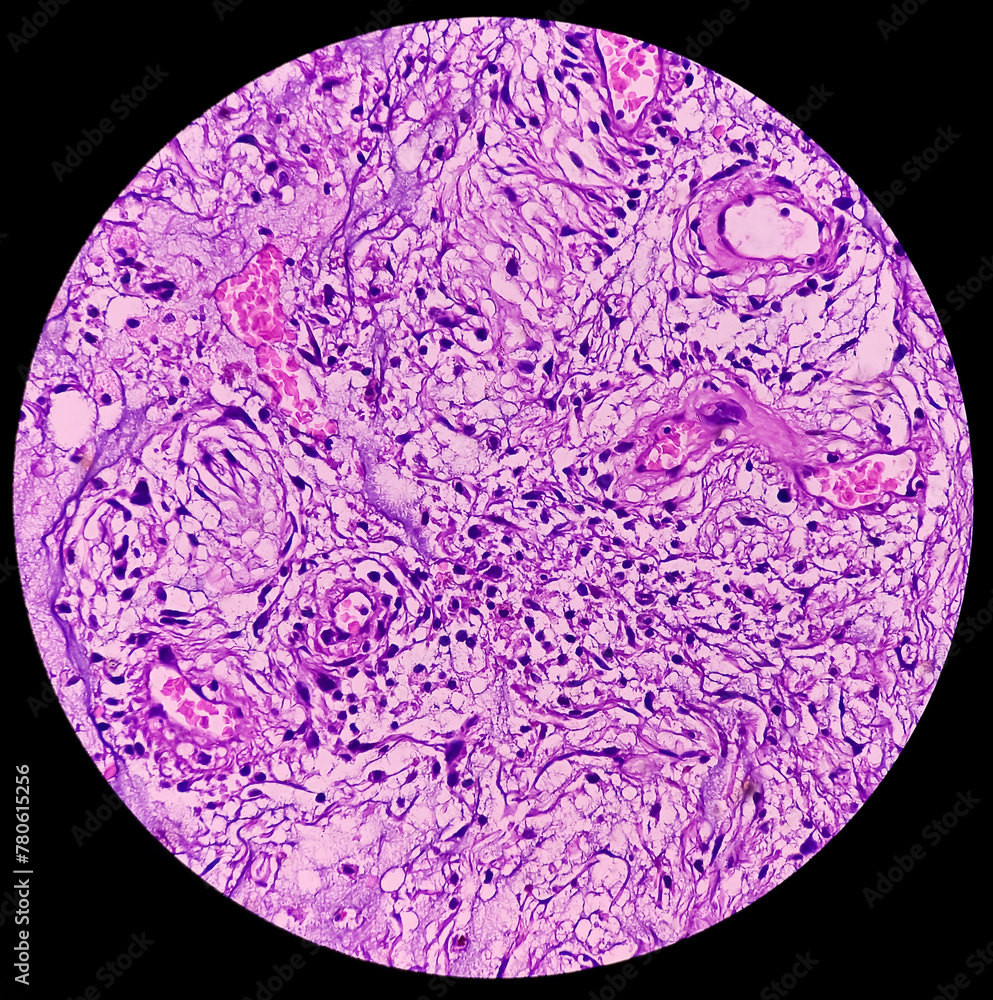 Salivary mucoid cyst. microscopic show parotid tissue, features of cyst ...