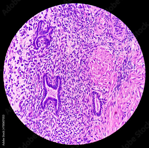 Microphotograph of endometrial tissue, reveals decidual change with necrosis and hemorrhage. Endometriosis. Endometrial or uterine cancer diagnosis. photo