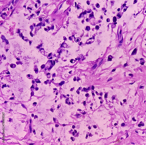 Bone cancer. Chondroblastic osteosarcoma. It's very rare cancer, microscopically show atypical mesenchymal cells, bizarre cells. photo