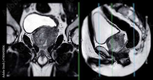 
MRI of the prostate gland reveals a focal abnormal signal intensity (SI) lesion at the left posterolateral peripheral zones at the apex, aiding in diagnosing tumors and guiding treatment decisions. photo