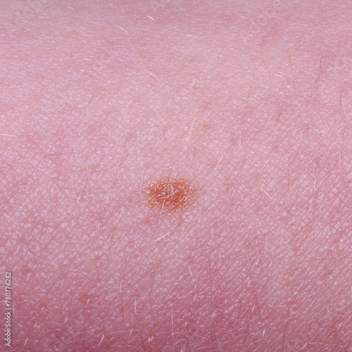 Mole or nevus on a child's skin photo