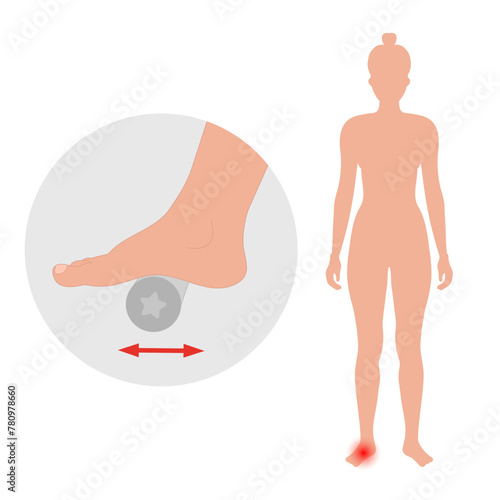 Special exercise for food deformation problem. Orthopedist Therapeutic and strengthening foot with fitness roller
