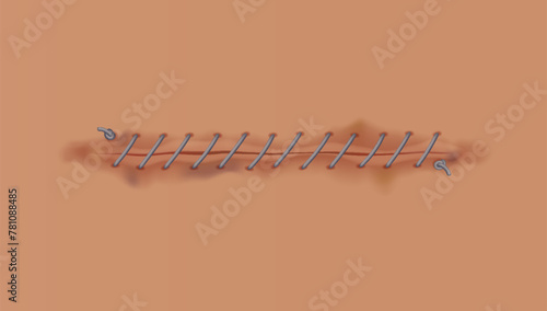 Healing wounds, skin scar, stitched gash and cut. Realistic surgical suture, stitched wounds. Healing stage on human skin background. Vector illustration