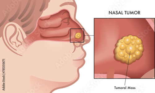 Medical illustration of a nasal tumor with a magnified detail.