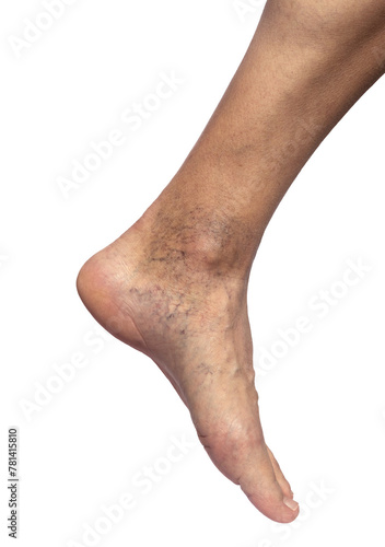 Leg of a person with vascular problems . Isolate on white background © Roman