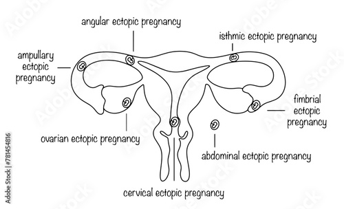 Ectopic pregnancy photo
