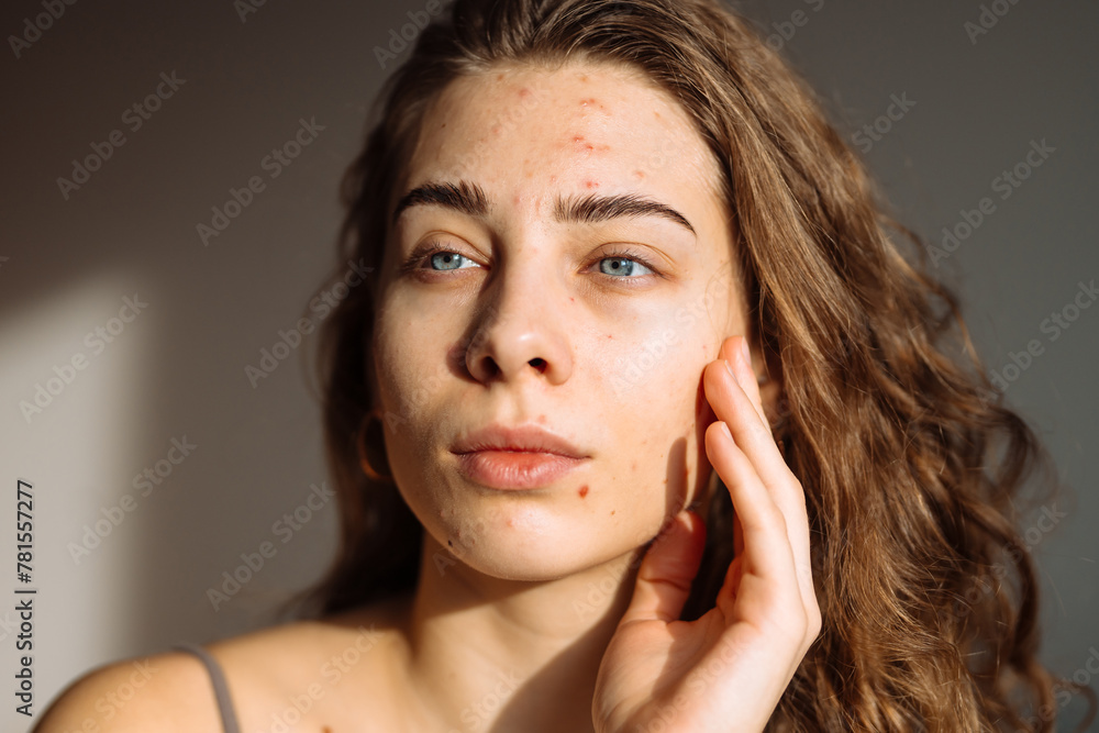 Portrait of a beautiful young woman with rash skin, scar, and red skin syndrome allergic to cosmetics. Medicine and cosmetology concept. Portrait of a beautiful young woman with rash skin, scar, and red skin syndrome allergic to cosmetics. Medicine and cosmetology concept.