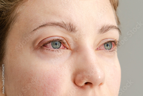 Close up of red irritated human eyes, allergy symptom, conjunctivitis
