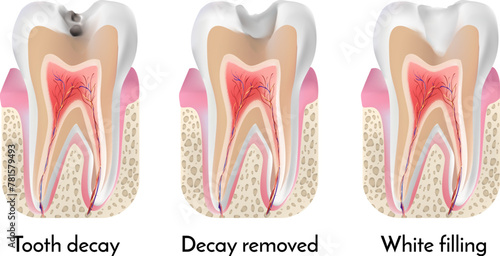 Tooth treatment stages. Tooth decay, decay removed, white filling
