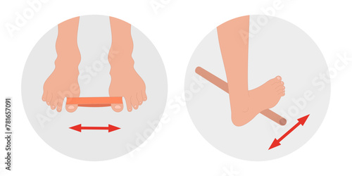 Special exercise for food deformation problem. Orthopedist Therapeutic and strengthening using fitness gum and stick